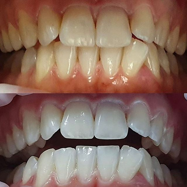 Lampe de blanchiment des dents